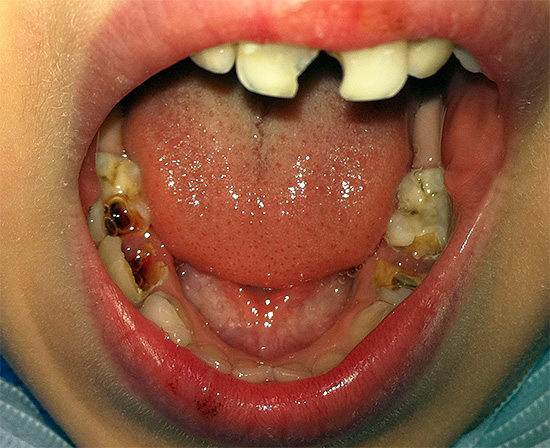 Og her er en mer alvorlig sak når karies allerede er komplisert av periodontitt.