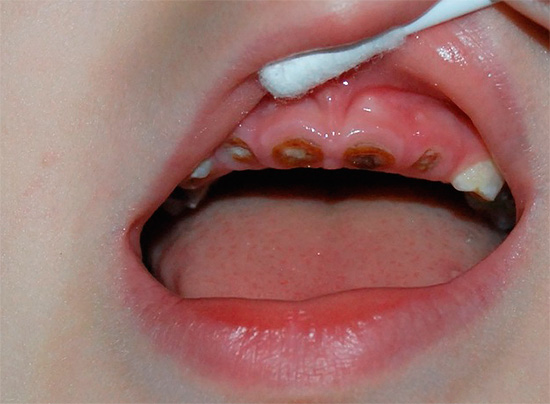 Sin el cuidado adecuado, los dientes de leche del bebé a una edad bastante temprana pueden simplemente pudrirse debajo de la raíz.