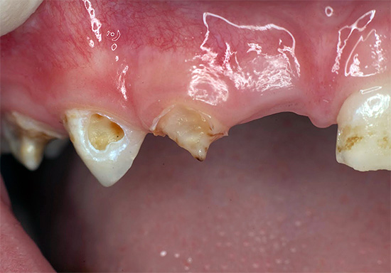 Fotografia prezintă un exemplu de degradare avansată a dinților de foioase