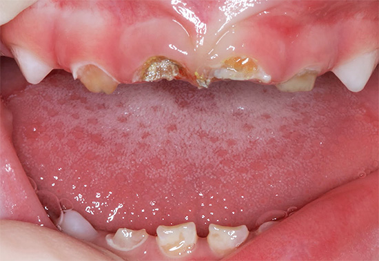 Zubní lekári bohužiaľ takéto obrázky pozorujú pomerne často.