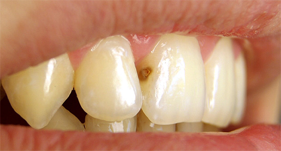 Ľudia spravidla venujú osobitnú pozornosť zubnému kazu na predných zuboch, pretože to priamo ovplyvňuje vzhľad osoby a jej celkový dojem.