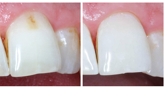 Aykon teknolojisini kullanarak tedavi öncesi ve sonrası ön diş böyle görünür