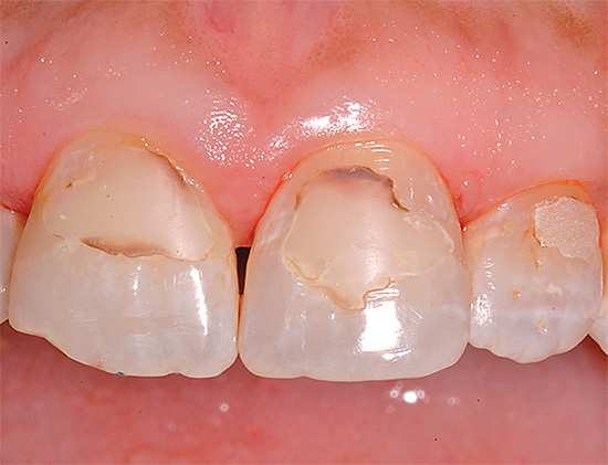 На фотографији је приказан пример секундарног каријеса на предњим зубима испод испуна.