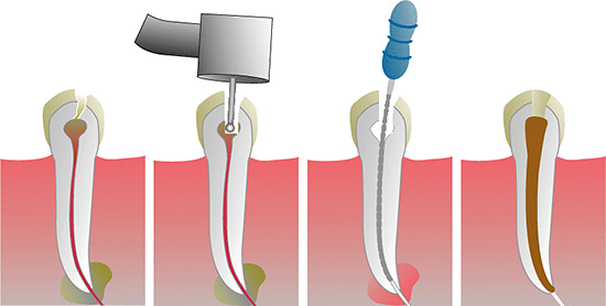 The main stages of pulpitis treatment