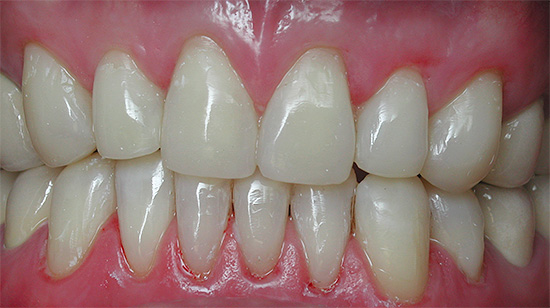 Gigi depan sepatutnya semulajadi selepas pemulihan.