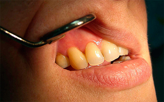 Nella maggior parte dei casi, il costo del trattamento della carie nei denti anteriori è aumentato.