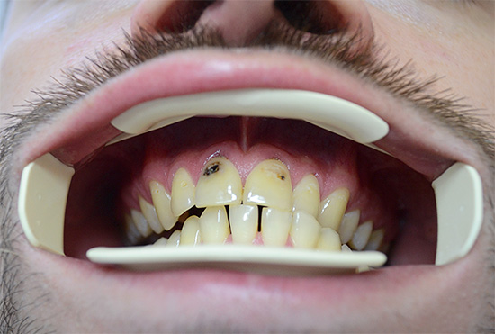 Vážné poškození rozpadu předních zubů může dokonce způsobit psychologické komplexy.
