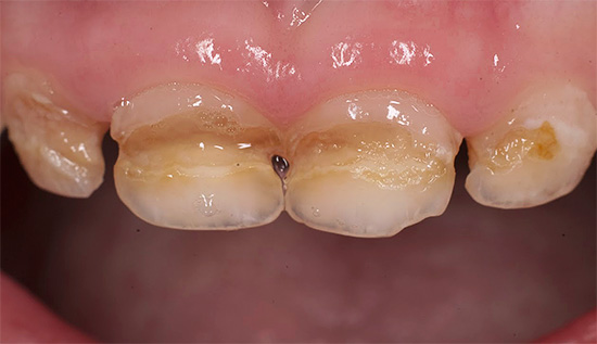 Un esempio di carie circolare dei denti primari anteriori