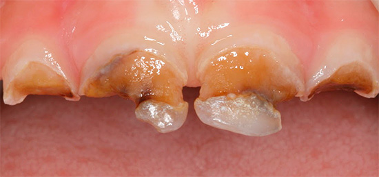 Bei fortgeschrittener kreisförmiger Karies kann die Zahnkrone eines Tages einfach abbrechen.