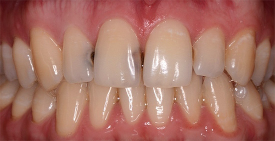 Kariess uz priekšējo zobu saskares virsmām