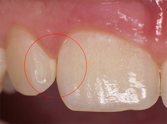 Zubný kaz vo fáze bielej škvrny
