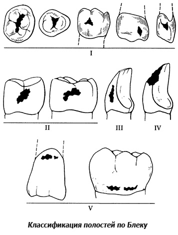 Classification des cavités cariées en noir