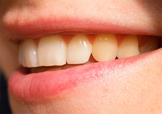Zložitosť obnovy predných zubov do značnej miery závisí od ich súčasného stavu.