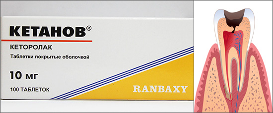 Laten we eens kijken hoe effectief Ketanov-tabletten kiespijn kunnen verlichten ...