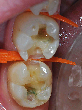 A properly formed cavity creates additional conditions for a strong seal retention.