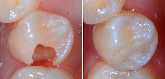 Di sebelah kiri dalam foto menunjukkan gigi dengan rongga terbentuk, dan di sebelah kanan - pandangan selepas memasang meterai.