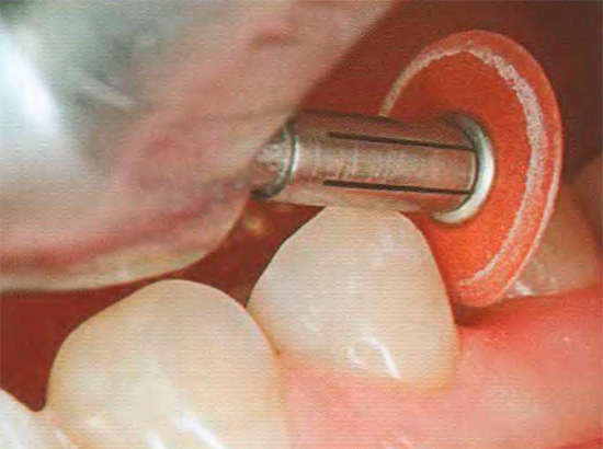 Rettifica di un dente dopo il restauro.