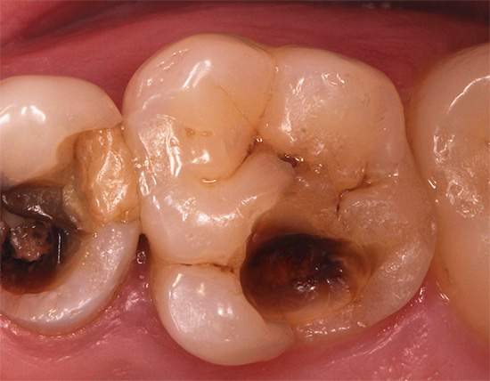 Bisher verwendete Füllmaterialien gingen von der Entfernung einer erheblichen Menge harten Zahngewebes aus, um die Füllung zuverlässig zu erhalten.