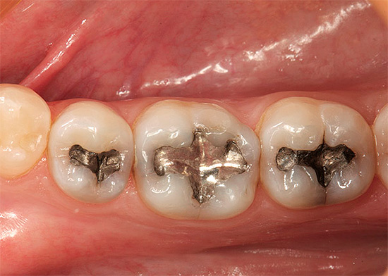 The disadvantage of amalgam fillings is their toxic mercury content.