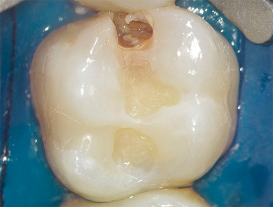 Vzhled moderních výplňových materiálů významně snížil objem vyříznuté zubní tkáně při léčbě kazu.