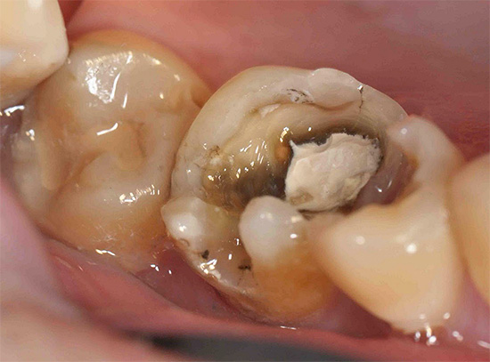 I de flesta fall är behandlingen av djupa karies mycket mer tidskrävande än i de inledande stadierna av tandröta.