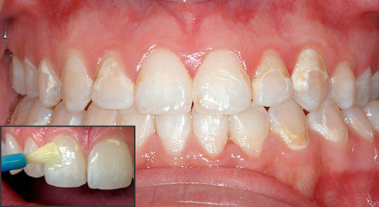 Remineralisoiva terapia antaa sinun kyllästää hammaskiili mineraalikomponenteilla ja palauttaa siten sen alkuperäiset ominaisuudet.