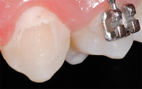 Beim Tragen von Zahnspangen kann es zu einer lokalen Demineralisierung des Zahnschmelzes kommen.