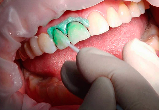 ICON caries treatment technology allows you to get very good results even in one visit.