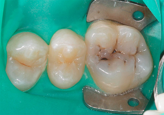 Foto van een tand met spleetcariës vóór behandeling