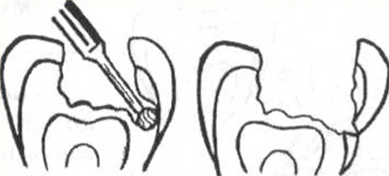 Pogreška u liječenju karijesa povezana s grubim kretanjem bora i prekomjernim pritiskom na jedan od zidova šupljine.
