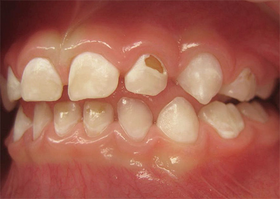 Εάν η θεραπεία δεν αρχίσει εγκαίρως, τότε η διαδικασία καταστροφής επηρεάζει σταδιακά τους βαθύτερους ιστούς του δοντιού ...