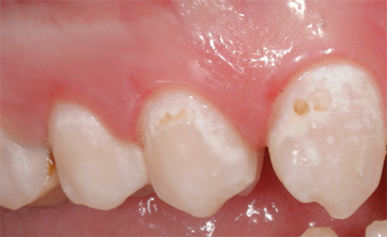 Konzervativní ošetření zubního kazu bez excize tkání vrtákem se používá hlavně v počátečních fázích demineralizace skloviny.