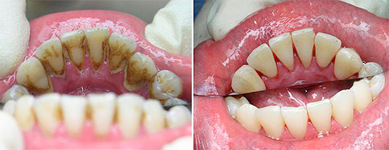 Vor dem Behandlungsvorgang werden Plaque- und Mineralablagerungen vom erkrankten Zahn (und manchmal von allen) entfernt.