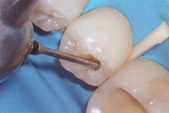 Langkah penting dalam prosedur adalah penyediaan gigi, di mana tisu-tisu yang dijangkiti dan berpigmen dikeluarkan.
