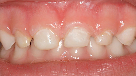 Počiatočný úpadok detských zubov dieťaťa - sú viditeľné biele oblasti demineralizácie skloviny