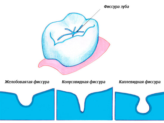The picture shows the various forms of tooth fissures