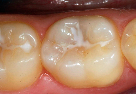 Uzavřené fisurové žvýkací zuby
