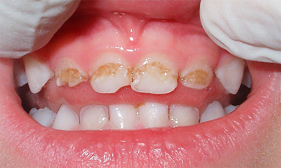 U većini slučajeva teško propadanje mliječnih zuba kod djece uglavnom je krivo za roditelje koji nisu previše pazili na preventivne mjere.