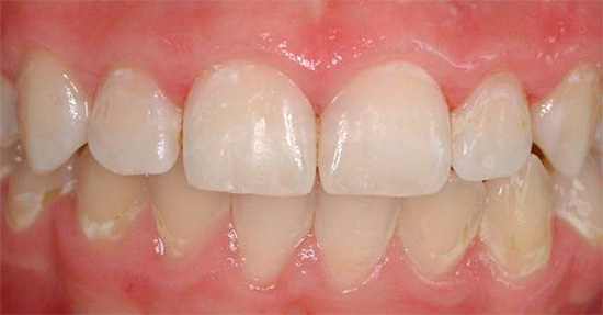 Das Foto zeigt ein Beispiel für die begonnene Demineralisierung des Zahnschmelzes (weiße Bereiche im zervikalen Bereich).