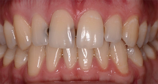 Príklad medzizubného kazu v predných zuboch