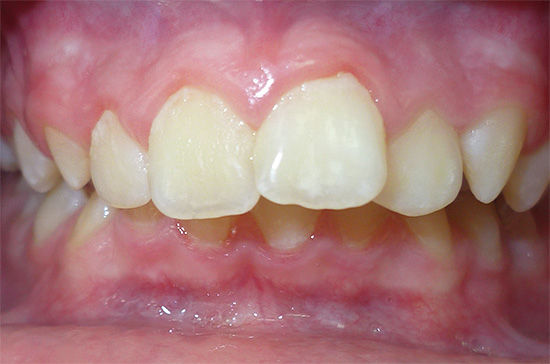Las anomalías de la mandíbula y la maloclusión a menudo contribuyen al desarrollo de caries.