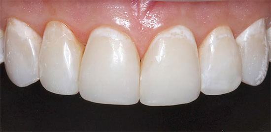 Initial caries in the stage of a white spot - in the cervical region of the teeth, foci of enamel demineralization are visible.