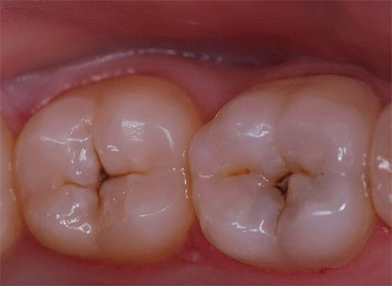 De nombreuses recettes populaires pour la carie dentaire ne contribuent en fait qu'à la destruction accélérée des dents.