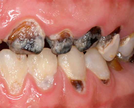 และดูเหมือนว่าฟันผุที่ถูกทอดทิ้งซึ่งสามารถพัฒนากับภูมิหลังของโรคบางชนิดและการขาดสุขอนามัยในช่องปาก