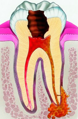 Na verloop van tijd kan pulpitis parodontitis veroorzaken.
