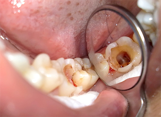 De wortelkanalen van de tand zijn zichtbaar op de foto - na reiniging worden ze verzegeld.