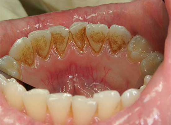 I denti inferiori sono più sensibili ai depositi minerali a causa del loro abbondante lavaggio con saliva.