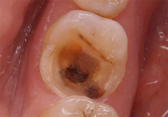 Често се обраћају за помоћ у напредним случајевима када гној с неугодним мирисом већ долази из зубног канала.