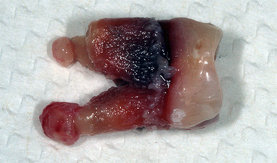 Fjernet tann med cyster på røttene