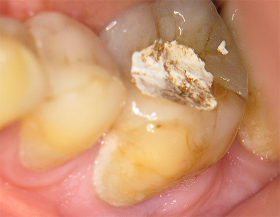 Umplerea temporară a dinților